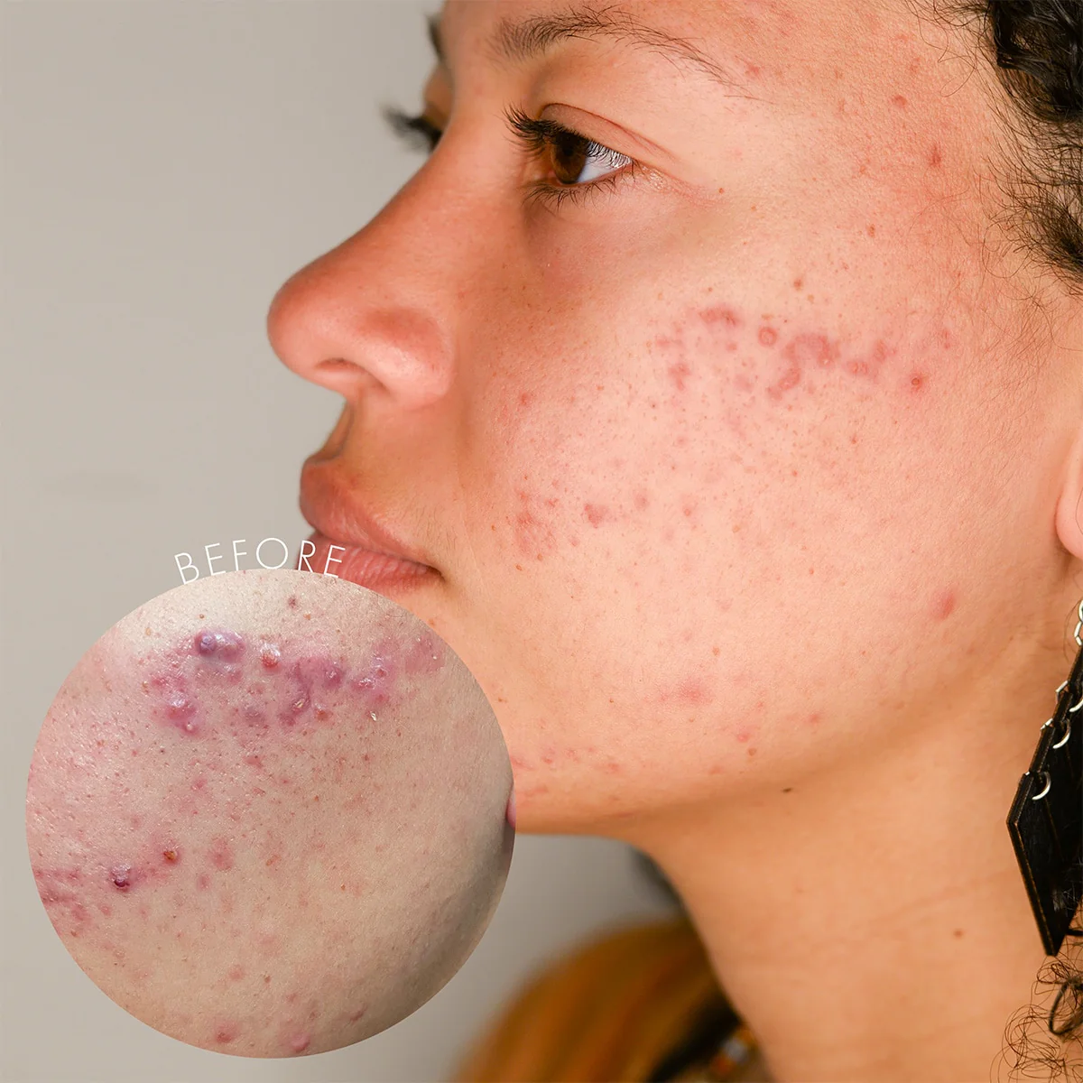 Clear Skin Peel - Image 2